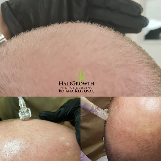 Har du upptäckt tecken på håravfall eller tunnhårighet? Hos Certifierad Hair Growth terapeut Bojana Klikovac kan du nu återfå hårväxten, samt motverka framtida håravfall. Här gäller det att boka in behandling snarast för att hinna stimulera hårbotten i tid! Före behandlingen är det nödvändigt att göra en Digital Skalp och Håranalys för att exakt kunna avgöra vilket sorts håravfall det rör sig om. Välkommen på Beauty Phix Center i Stockholm!