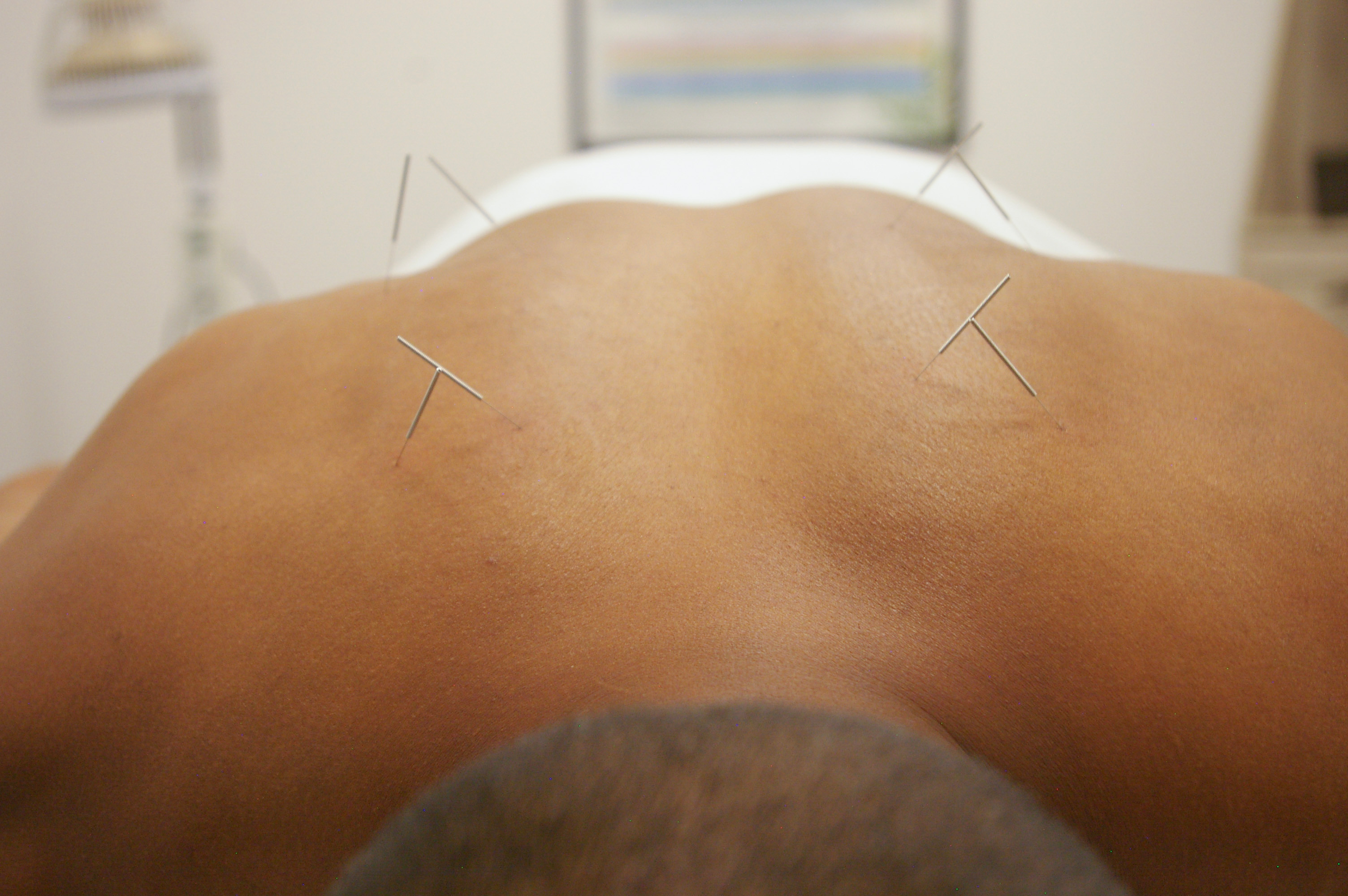 Acupuncture Energetics 東洋医学 4PointsHealthAndWellness-