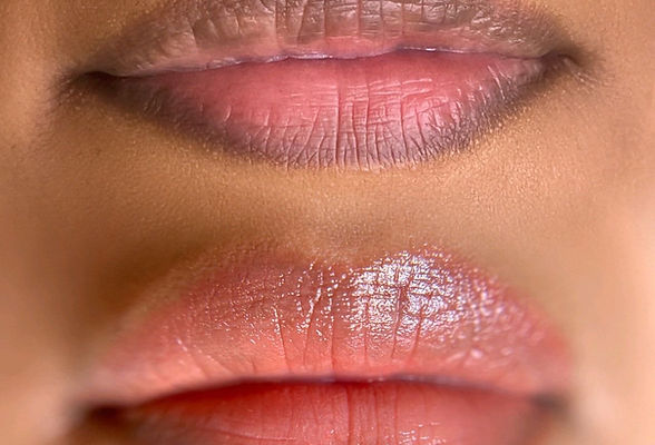 Dark Lip Neutralization Maryland