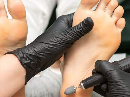 Callus Removal Treatment | Bali