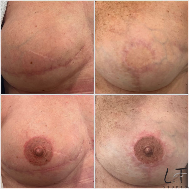 areola tattoo