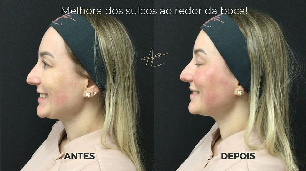 Antes x Depois do CoolFase pela Dra. Alessandra Catharino