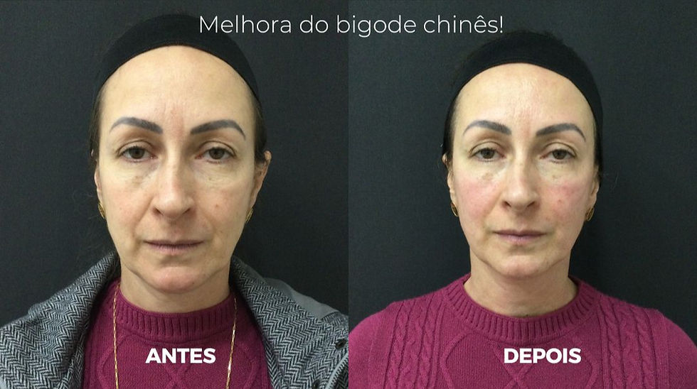 Antes x Depois do CoolFase pela Dra. Alessandra Catharino
