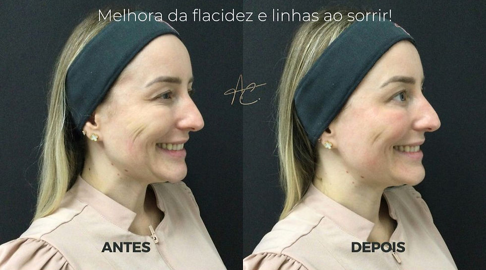 Antes x Depois do CoolFase pela Dra. Alessandra Catharino