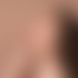 Laser Quadri Pico: tecnologia avançada para rejuvenescimento, melasma e hiperpigmentações