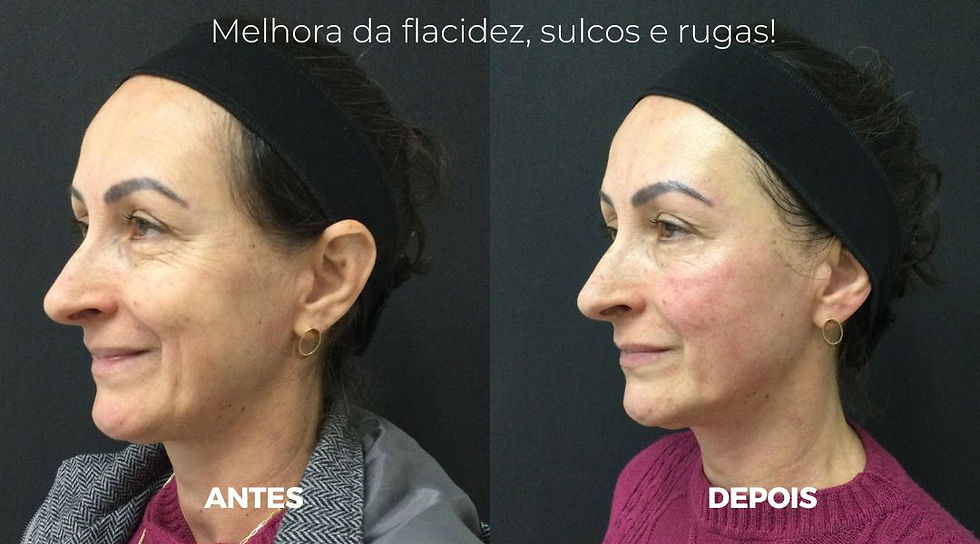 Antes x Depois do CoolFase pela Dra. Alessandra Catharino