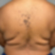 Dermatosis Papulosa Nigra (DPN) and Seborrheic Keratosis (SK) Treatment Before and After by Brave Skin Remedy