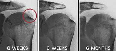 shockwave-calcific-tendonitis.png