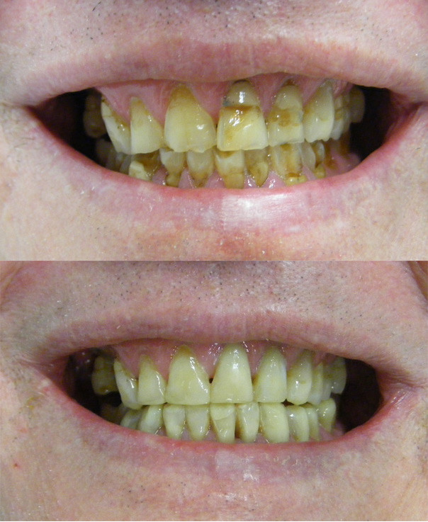 Acid erosion from lemons