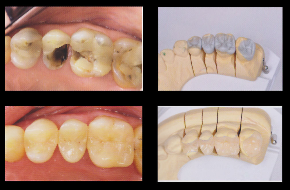 Porcelain onlays and Gold onlays