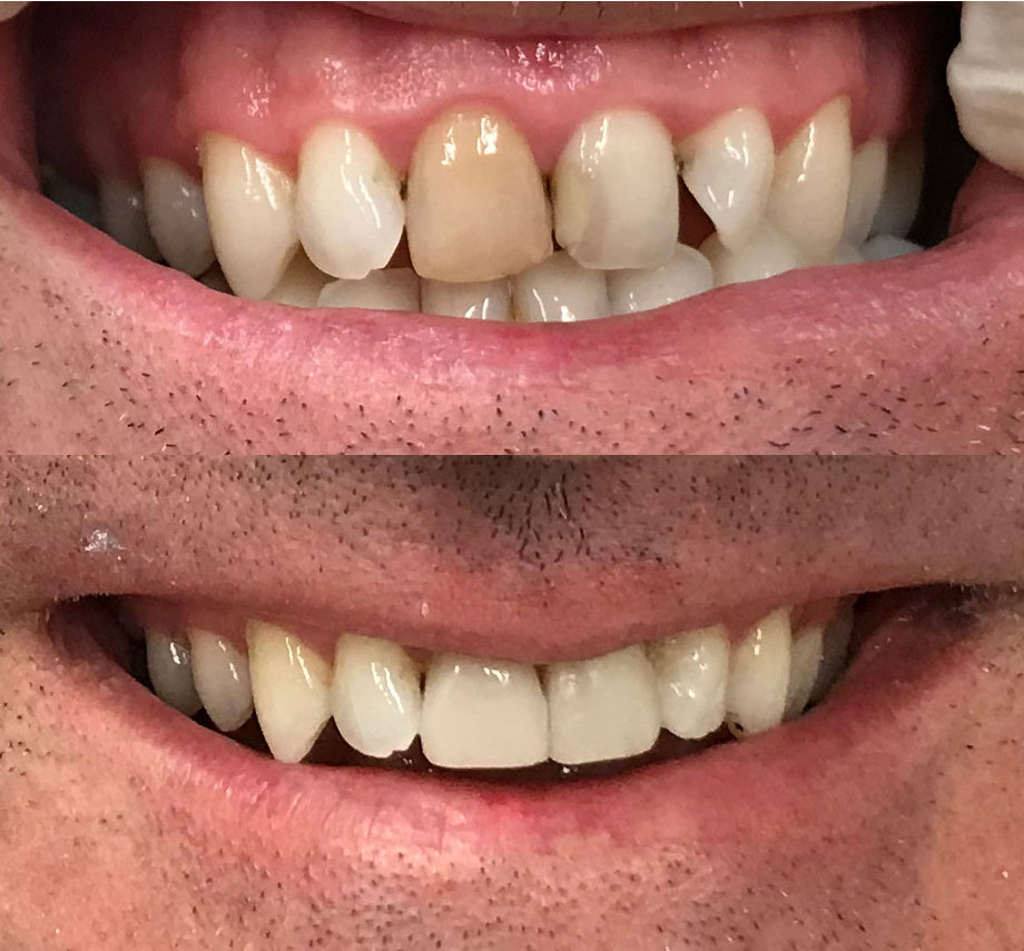 Three Composite Veneers by Kim