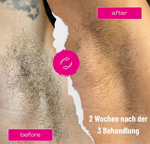 Laser Armpit Before After Collage Instagram Post.JPG