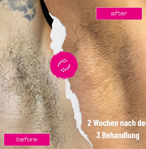 Laser Armpit Before After Collage Instagram Post.JPG