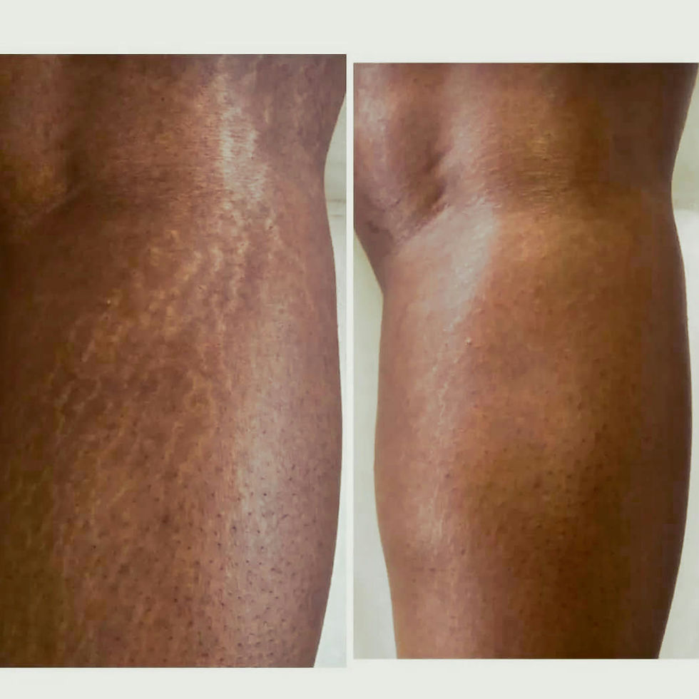 Thumbnail: STRETCH MARKS REMOVER LOTION