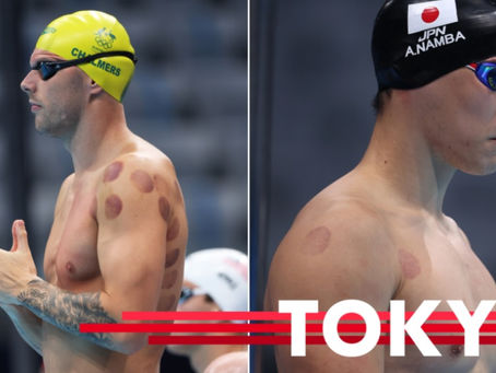 Cupping Therapy…Athletes love it!