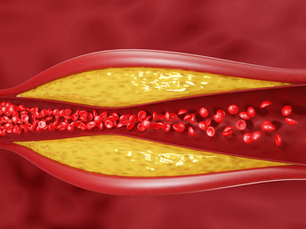 Why I'm aggressive about my cholesterol