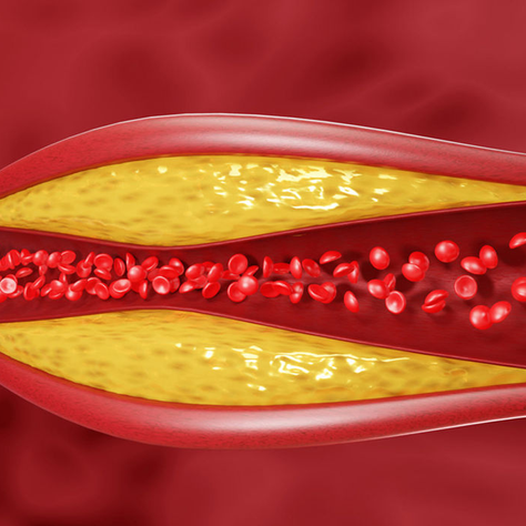 Why I'm aggressive about my cholesterol