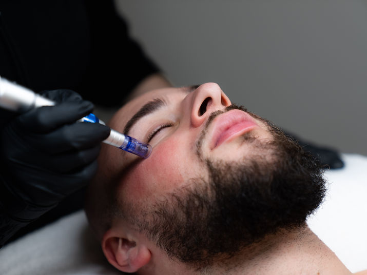 microneedling
