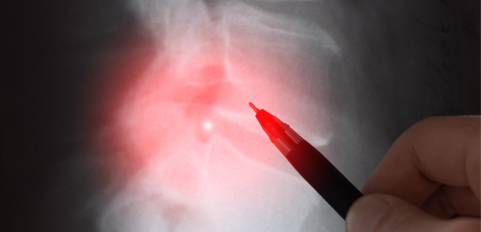 radiologie Disques Intervertébraux