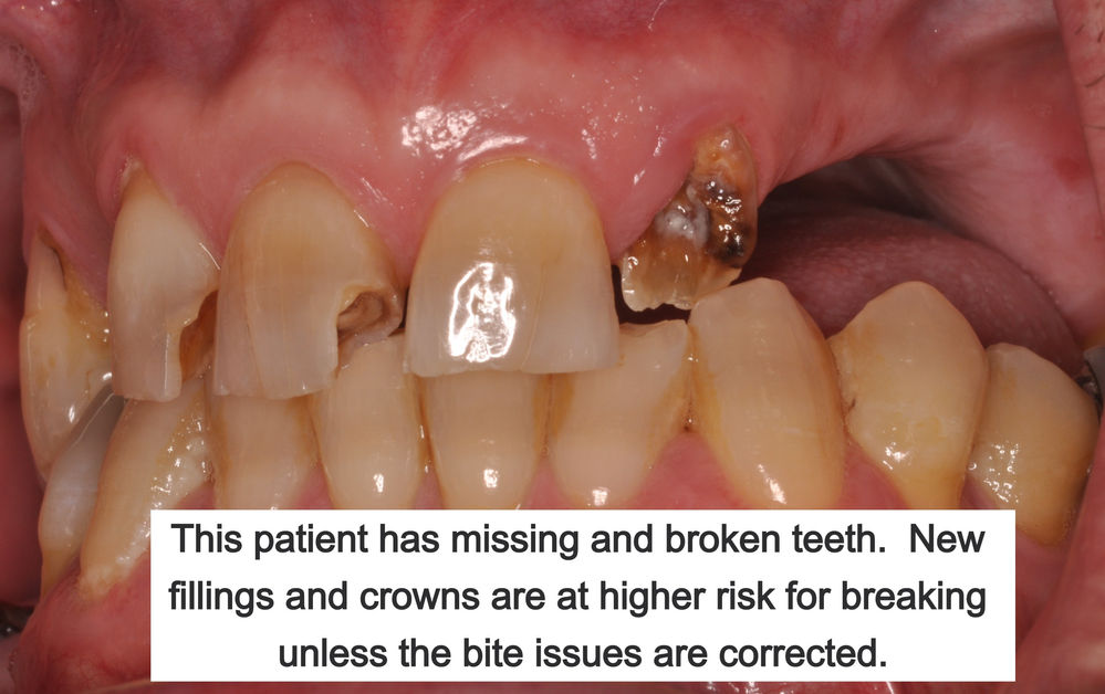 How long should a filling or a crown last?