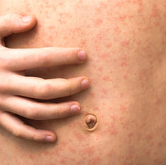 Measles Outbreak