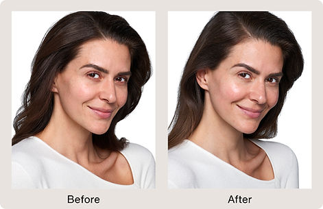Derma Fillers Before & After 1