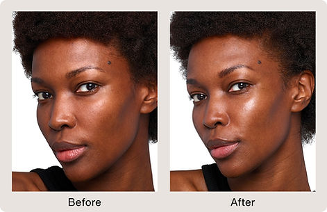 Derma Fillers Before & After 2