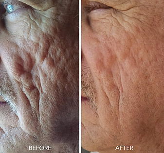 Microneedling before and after