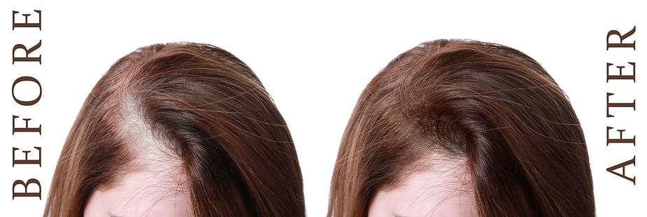 Before and After Hair Regeneration cryotherapy cryo t-shock botox microneedling