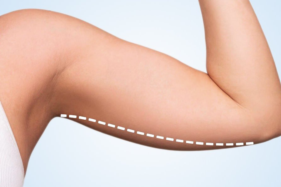 sculptiq-arm-lift-brachioplasty-surgery-procedure-02_edited.jpg