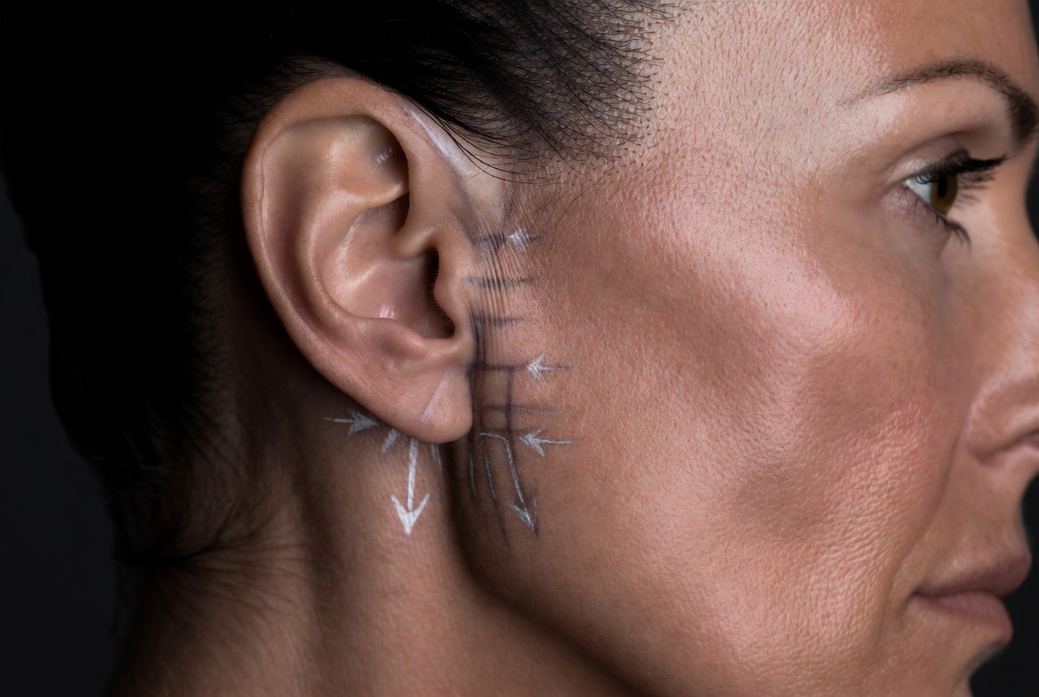 sculptiq-otoplasty-procedure-02.jpeg