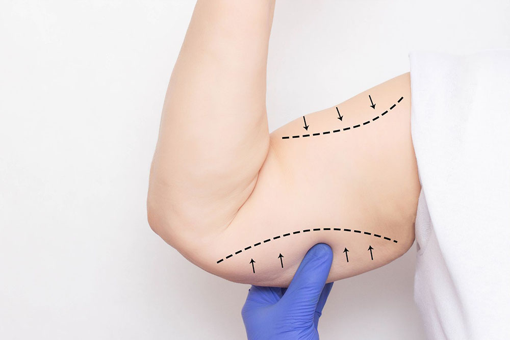 sculptiq-arm-lift-brachioplasty-surgery-procedure-01.jpg