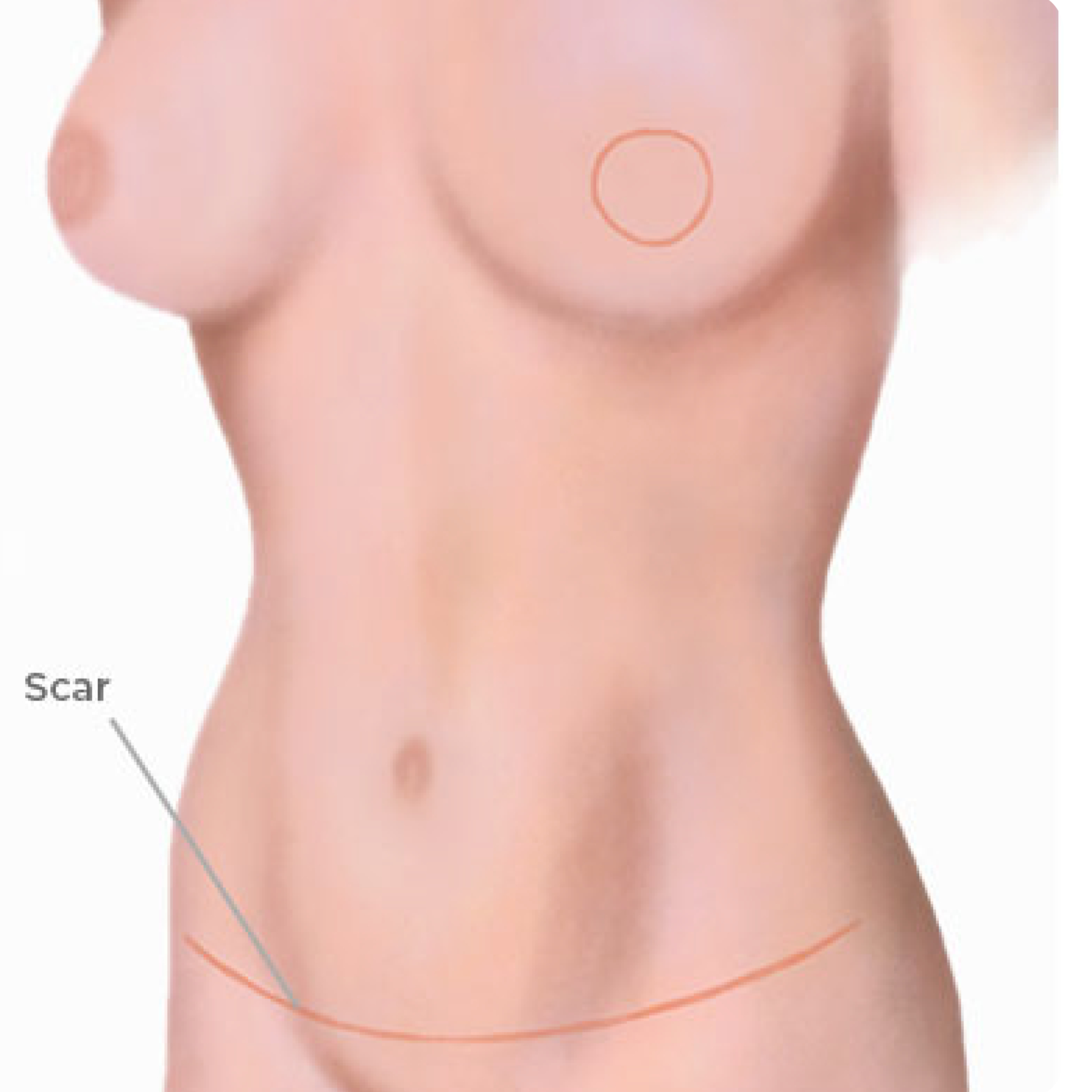 Step7-DFY-04 - Abdom Flap Recon Surgery Images_Abd Flap