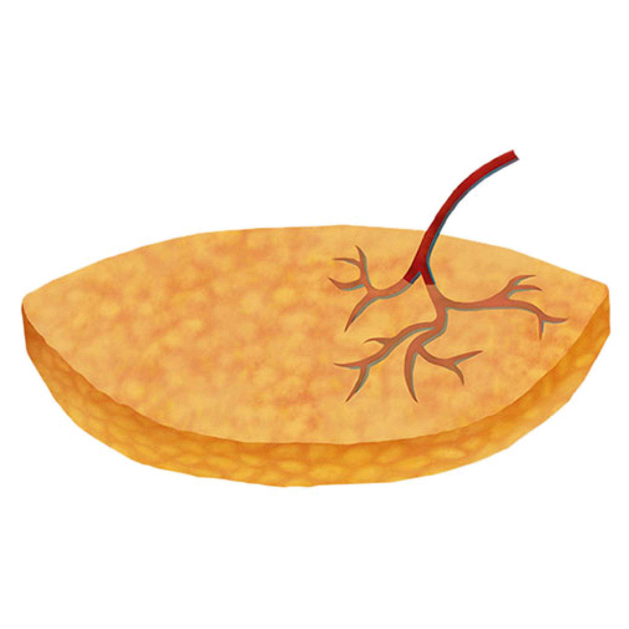Step4-DFY-04 - Abdom Flap Recon Surgery Images_Abd Flap