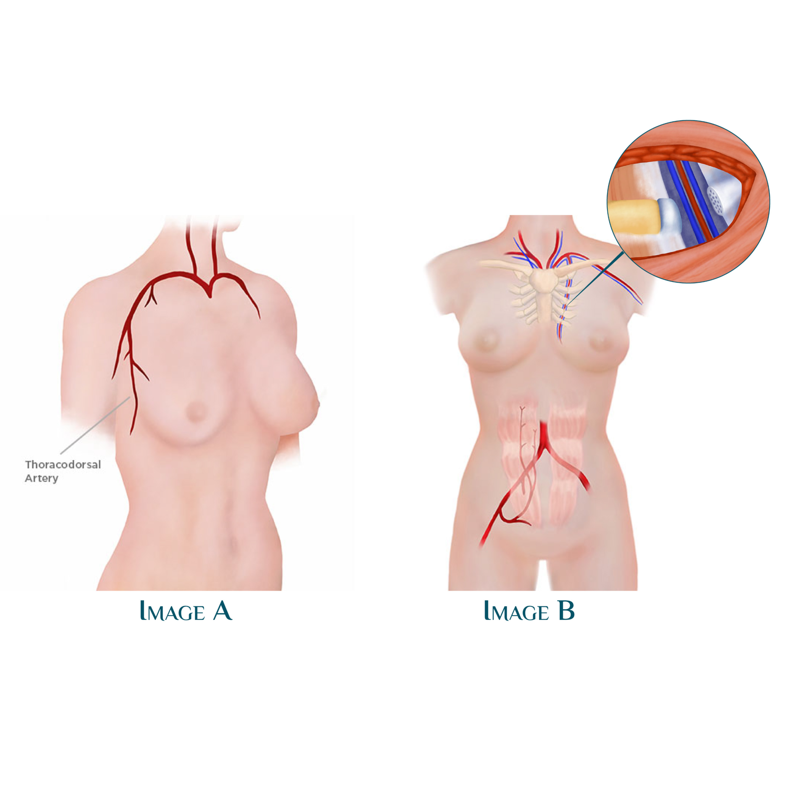 Step5-DFY-04 - Abdom Flap Recon Surgery Images_Abd Flap