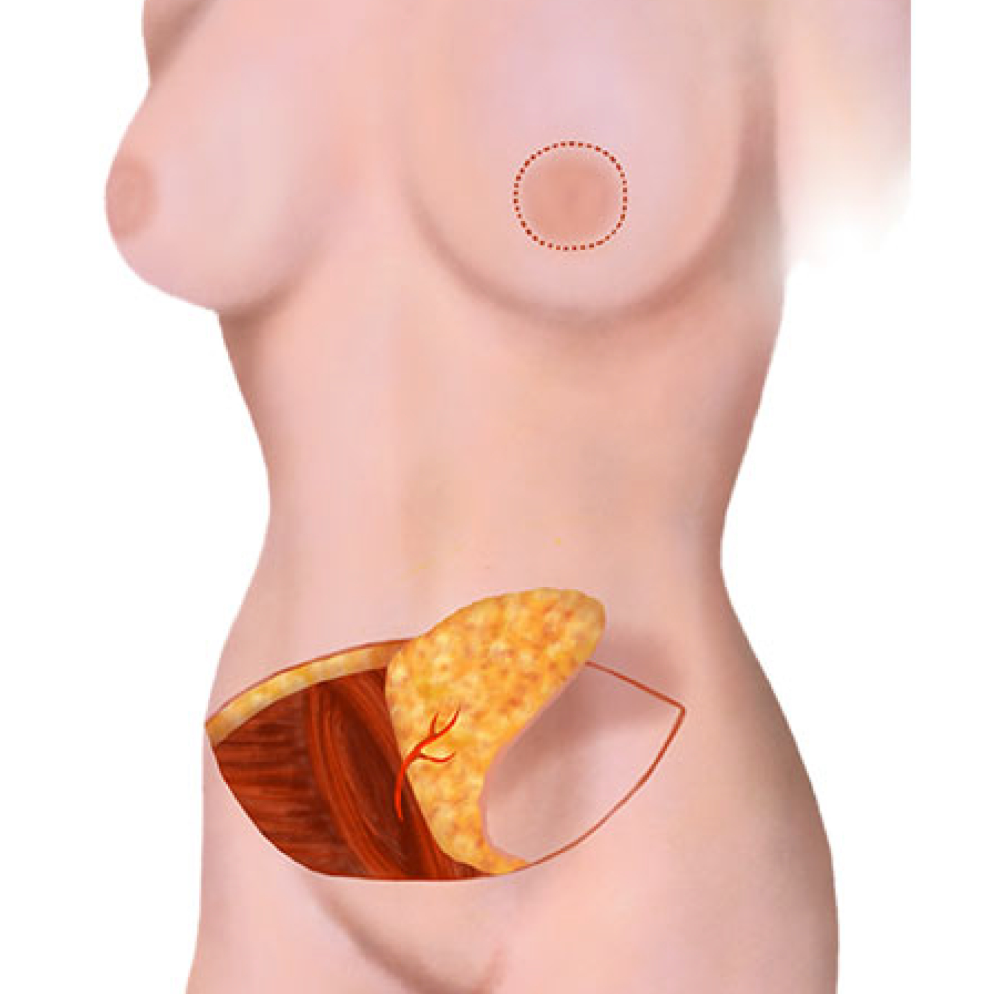 Step2-DFY-04 - Abdom Flap Recon Surgery Images_Abd Flap