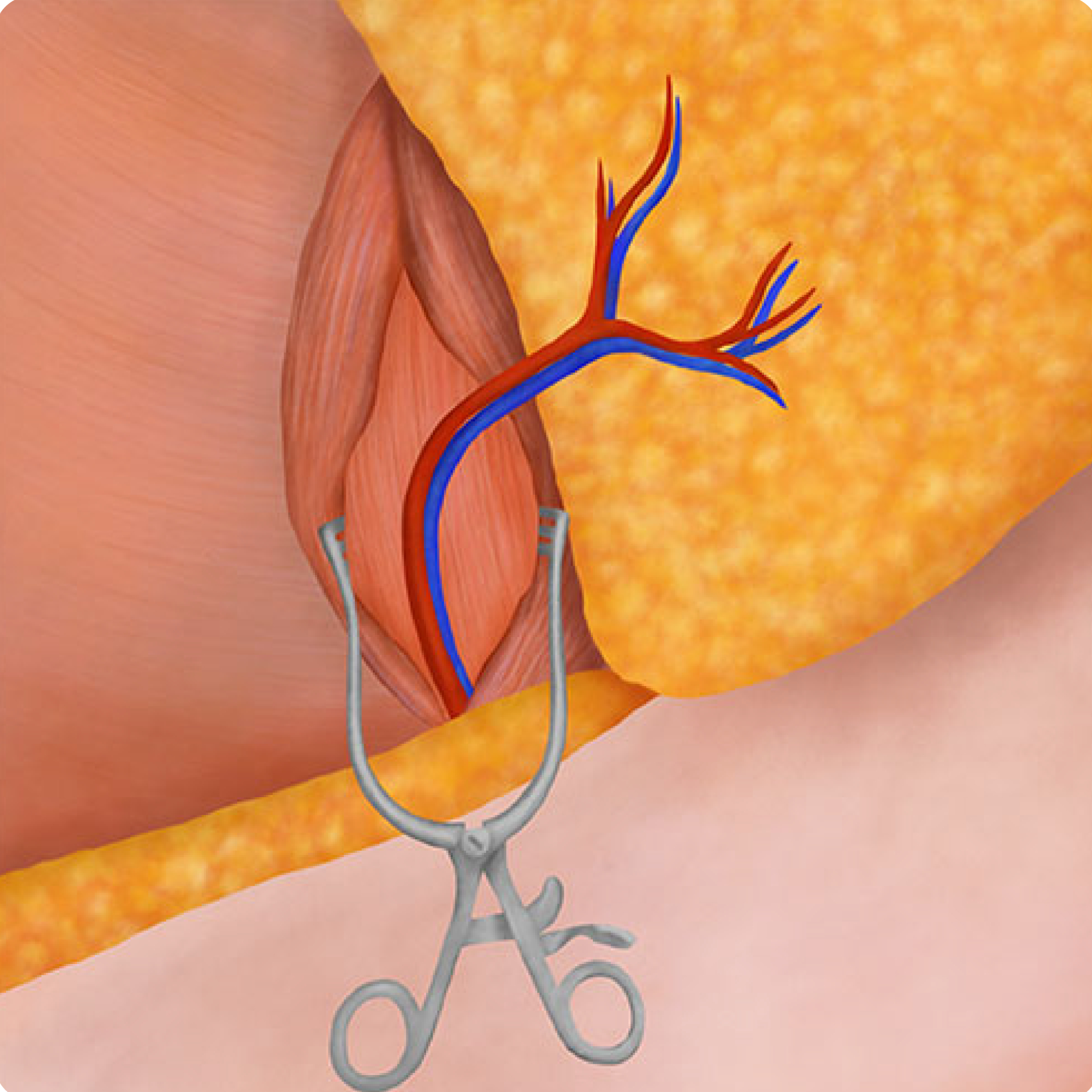 Step3-DFY-04 - Abdom Flap Recon Surgery Images_Abd Flap