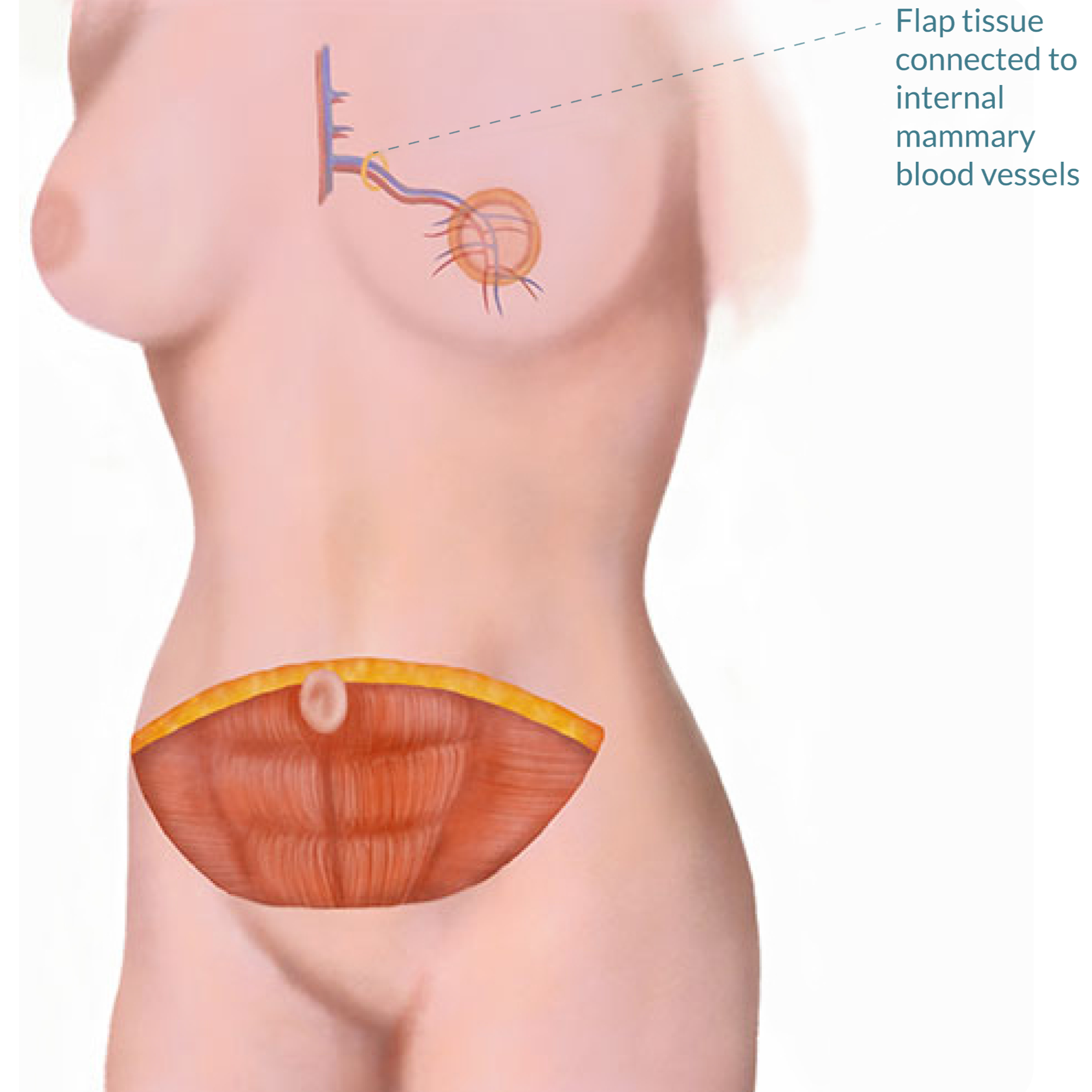 Step6-DFY-04 - Abdom Flap Recon Surgery Images_Abd Flap