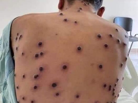 Descarta Salud Sonora casos positivos de viruela símica en la entidad