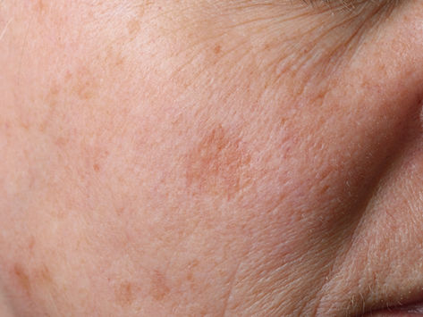 217572 - 8-Week Dark Spot Brightening Study - Study Details - £150