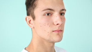 217249 - 8-Week Post-Blemish Mark Reduction Study - £150