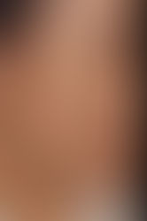 Melasma Treatment
