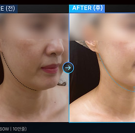 lifting treatment to firm and lift skin