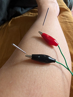 electroacupuncture-hidden-root-acupuncture.jpg