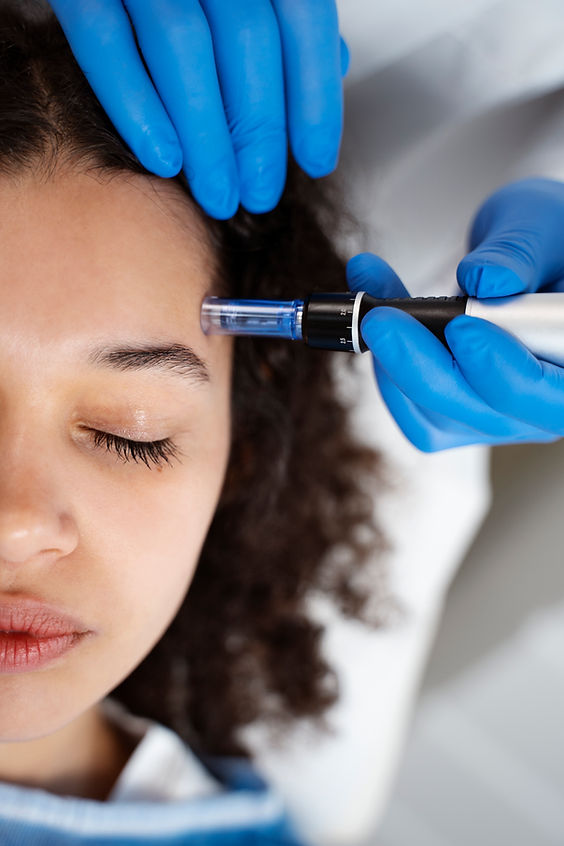 What Does Microneedling Do? Patient receiving a microneedling treatment