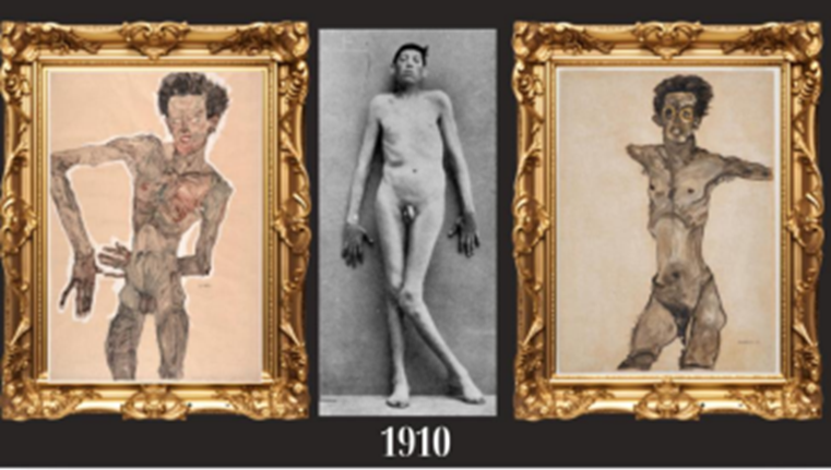 Confronto tra una fotografia di un uomo deformato e gli autoritratti di Egon Schiele. L’artista viennese attribuisce una grande importanza alle mani, dettaglio visibile anche nei documenti di Jean-Martin Charcot. Sia le mani dell’uomo sia quelle di Schiele appaiono deformate, in posizioni convulse. Anche la magrezza e la malattia sono messe in rilievo: le braccia sono sproporzionate rispetto al torso, creando un senso di inquietudine.