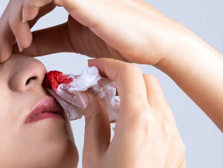 Nosebleeds and how to treat them