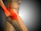 Hip Impingement