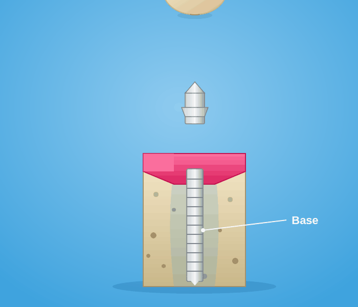 dental-implant (1).gif