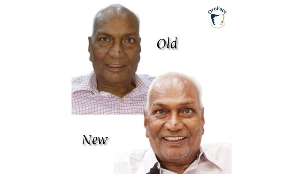 1920 x 1120 px)Before After Implant Image Oroface Navi mumbai 